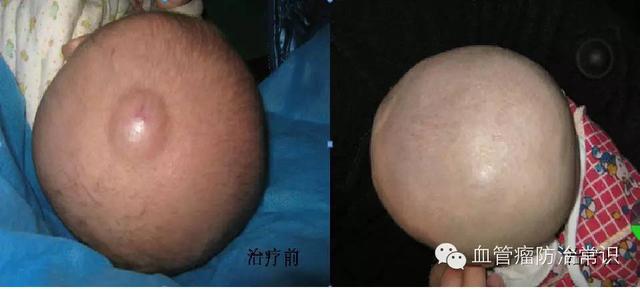 修殘補(bǔ)缺道 醫(yī)美整形路——幫寶寶遠(yuǎn)離紅斑-血管瘤