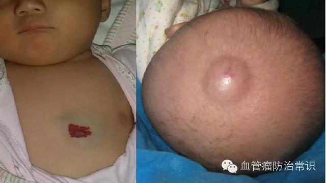修殘補(bǔ)缺道 醫(yī)美整形路——幫寶寶遠(yuǎn)離紅斑-血管瘤