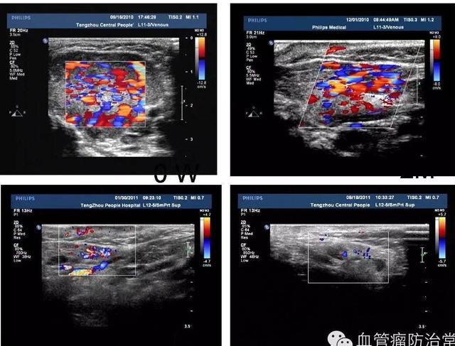 修殘補(bǔ)缺道 醫(yī)美整形路——幫寶寶遠(yuǎn)離紅斑-血管瘤