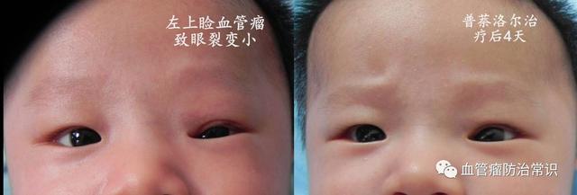 修殘補(bǔ)缺道 醫(yī)美整形路——幫寶寶遠(yuǎn)離紅斑-血管瘤