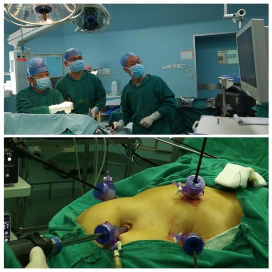 肝膽血管外科獨(dú)立開(kāi)展腹腔鏡下肝血管瘤切除術(shù)